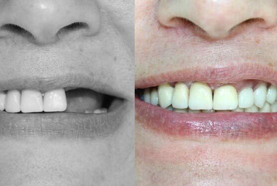 <span style="font-weight: bold;">ИМПЛАНТАЦИЯ</span>