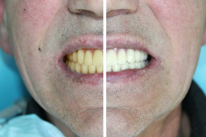 <span style="font-weight: bold;">ОТБЕЛИВАНИЕ</span>